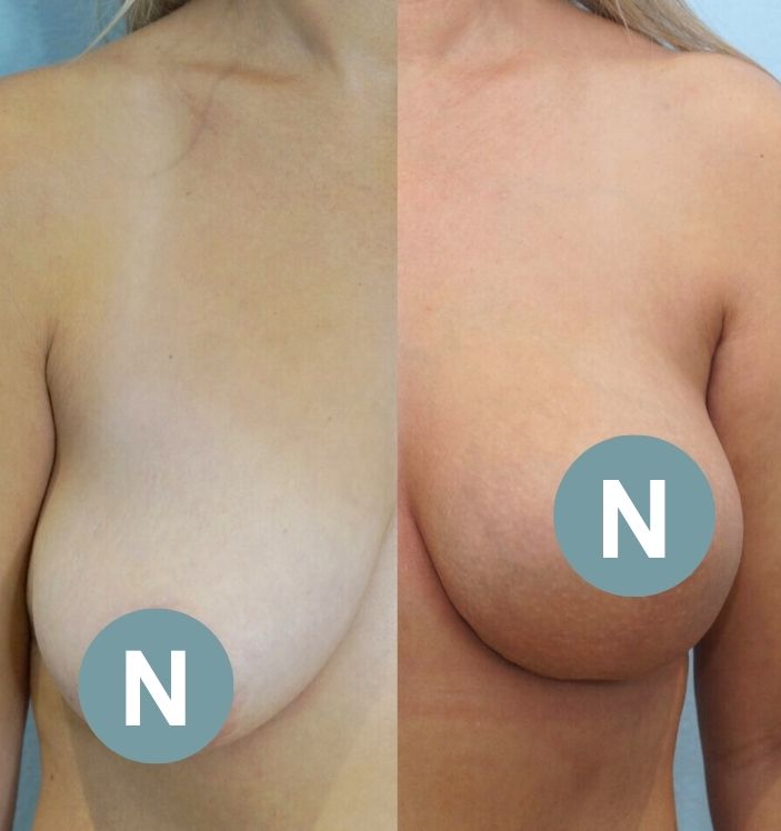 breast lift with implants